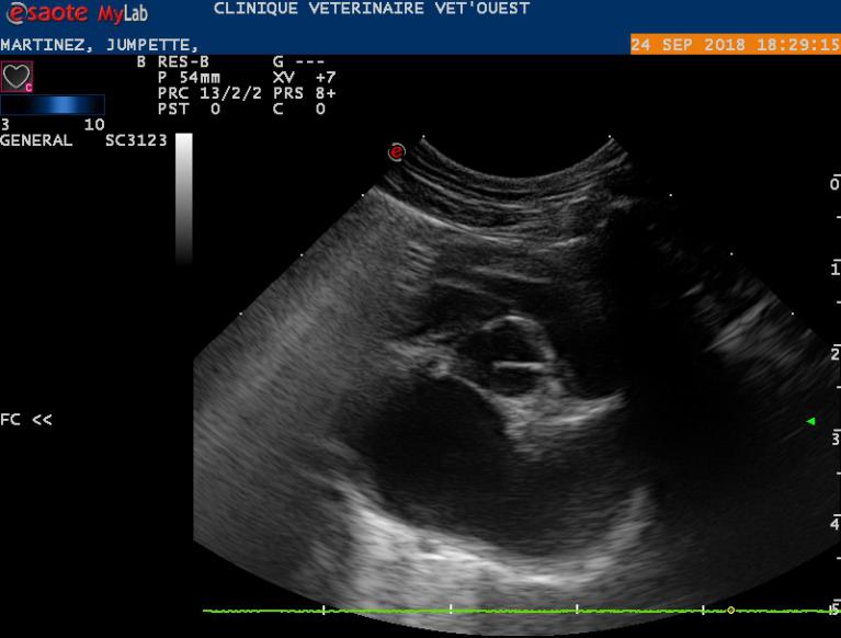 Dilatation atriale gauche à l'origine du thrombus