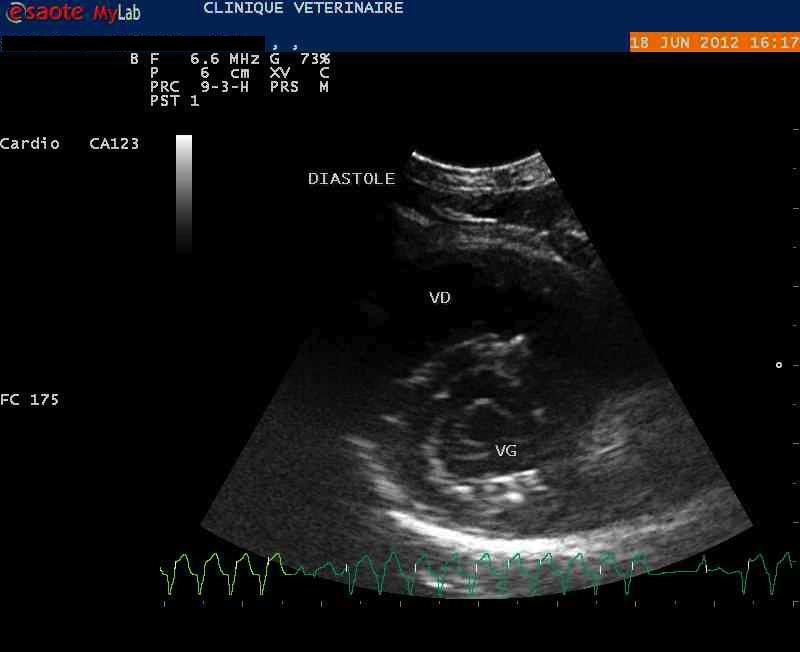 Dilatation du VD