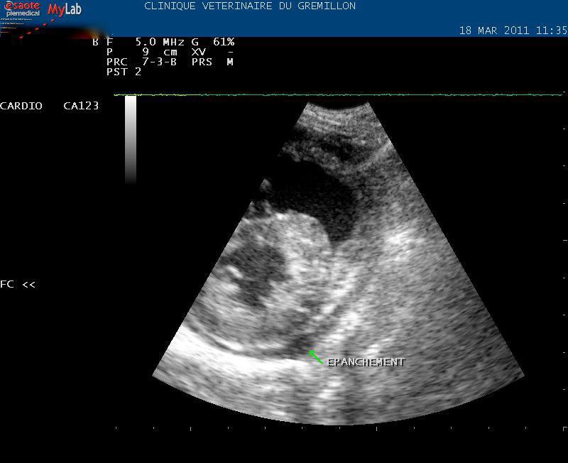 Dilatation du VD associée à une légère péricardite