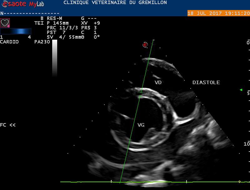 Cardiomégalie dilatée associée à une péricardite importante