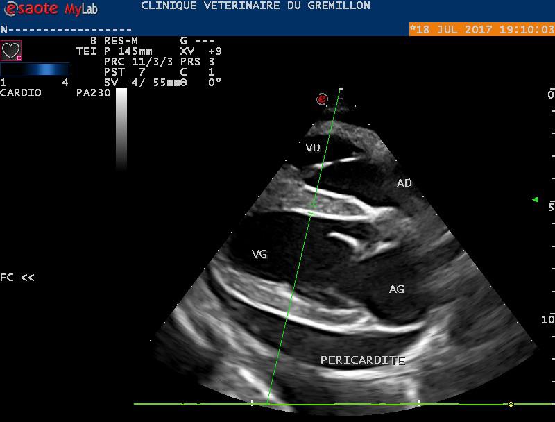 Présence d'une péricardite visible sur une coupe 4 cavités par abord droit