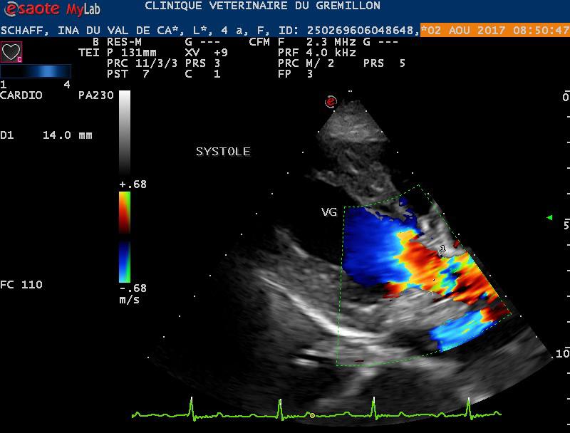 Retrecissment de l'anneau aortique: sténose aortique (fibrose de l'anneau)