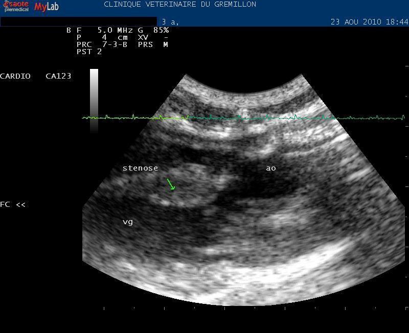 Bourrelet musculaire sur le septum en region sous aortique: sténose sous aortique