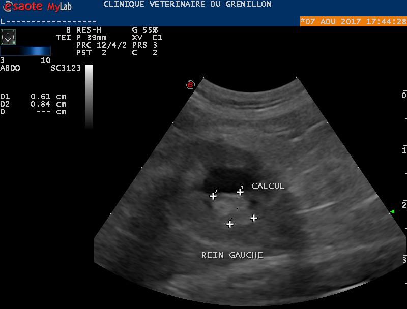 Calcul de 6 mm dasn le bassinet d'un atrésié suite à une hydronephrose