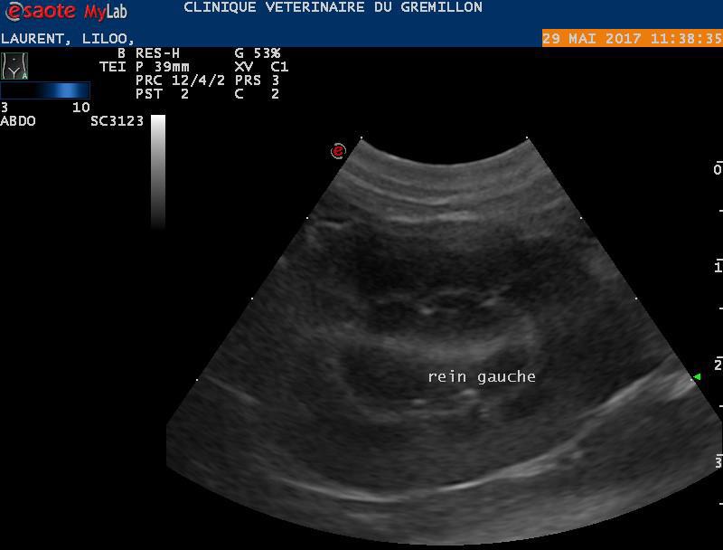 Rein: épaississement de la corticale rénale, echogénicité de la jonction cortico-medullaire