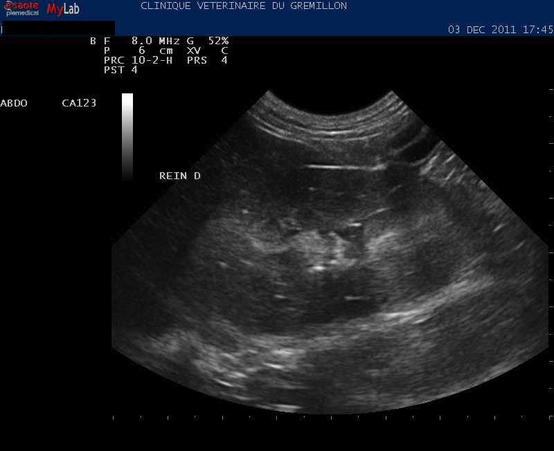 Rein: épaississement et fibrose importante de la corticale rénale