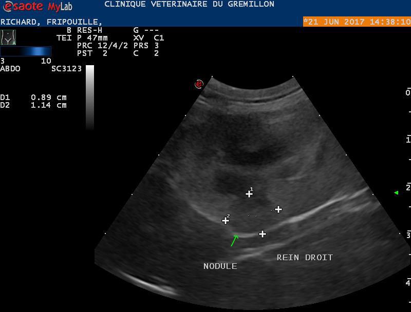 Rein: nodule au niveau de la cortical, metastase probable