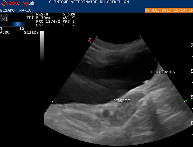 Vessie: présence d'un calcul urinaire