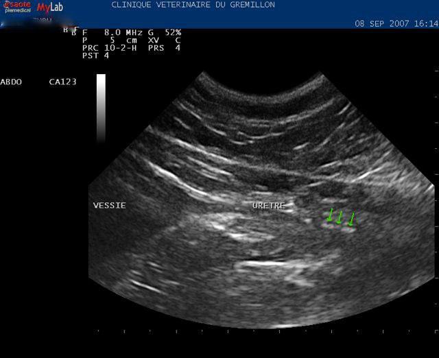 Urètre: présence d'un chapelet de calculs dans l'uretre