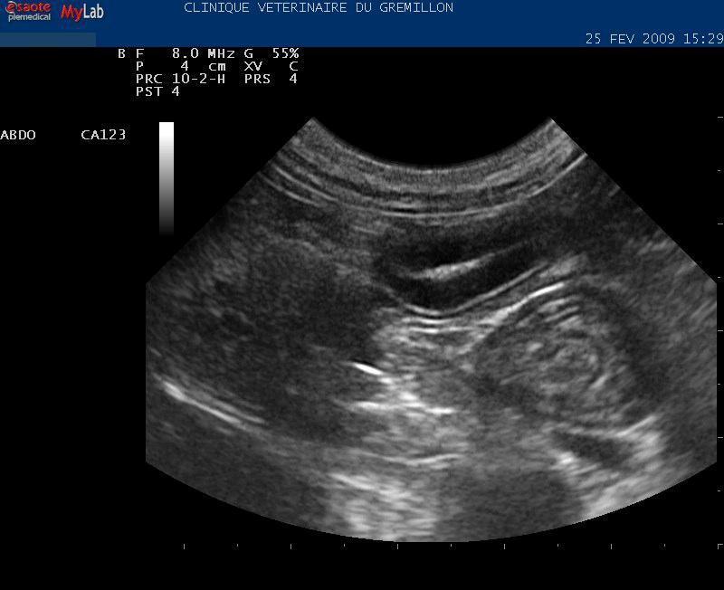 Intusception intestinale