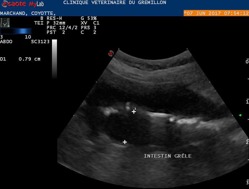 Epaississement de la musculeuse intestinale