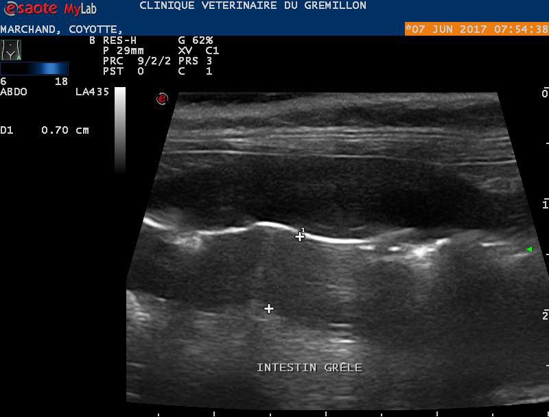 Epaississement de la musculeuse intestinale