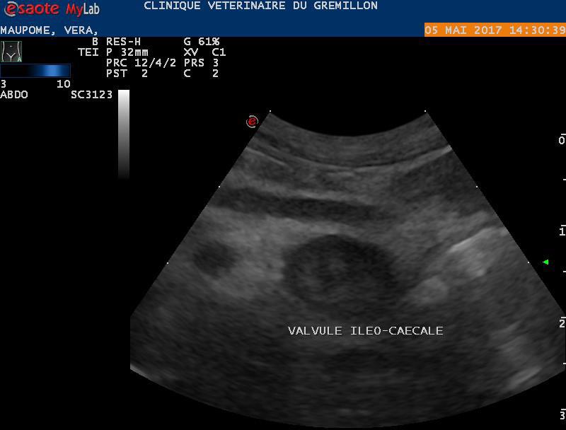 Inflammation de la valvule iléo-caecale