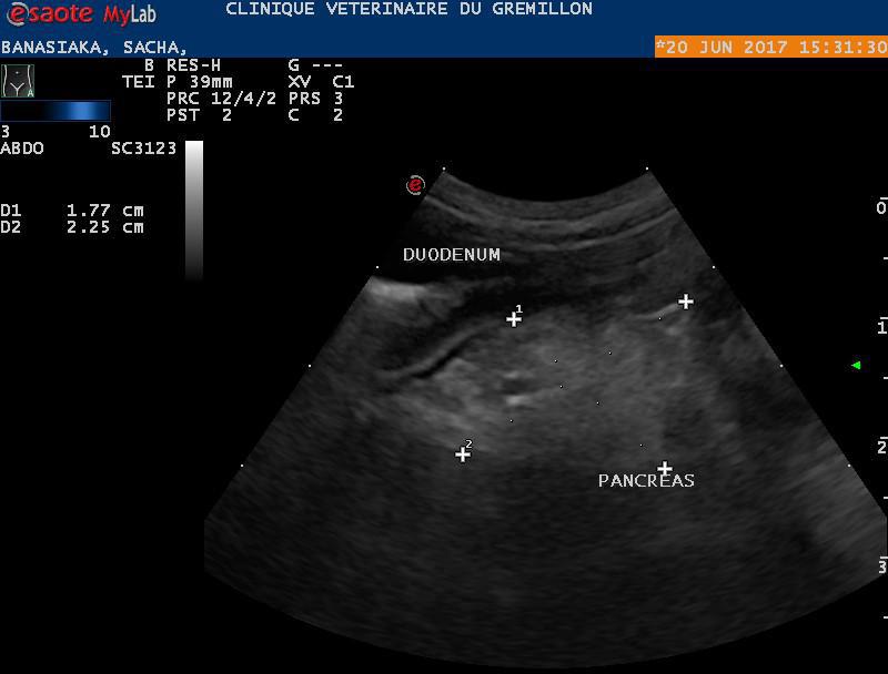 Pancreatite sub-aigue