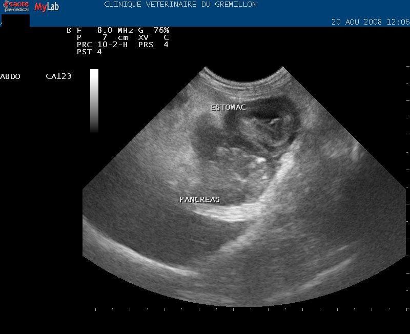 Necrose calcifiée sur le pancreas