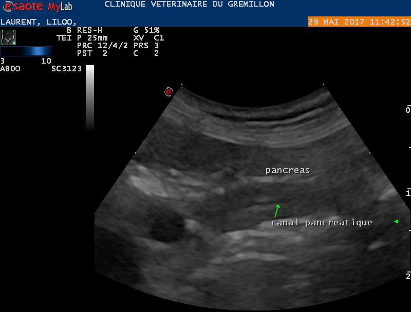 Pancreatite aigue, forte inflammation du canal pancreatique