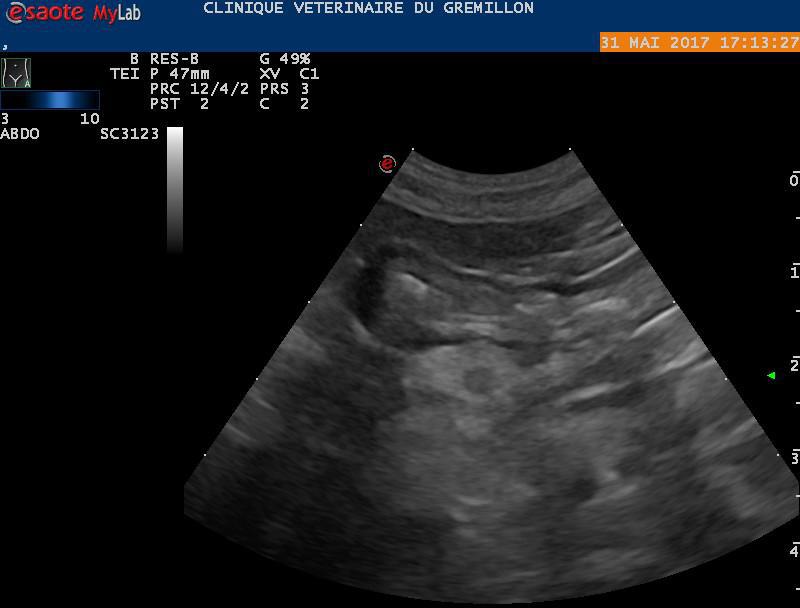 Pancreatite chronique