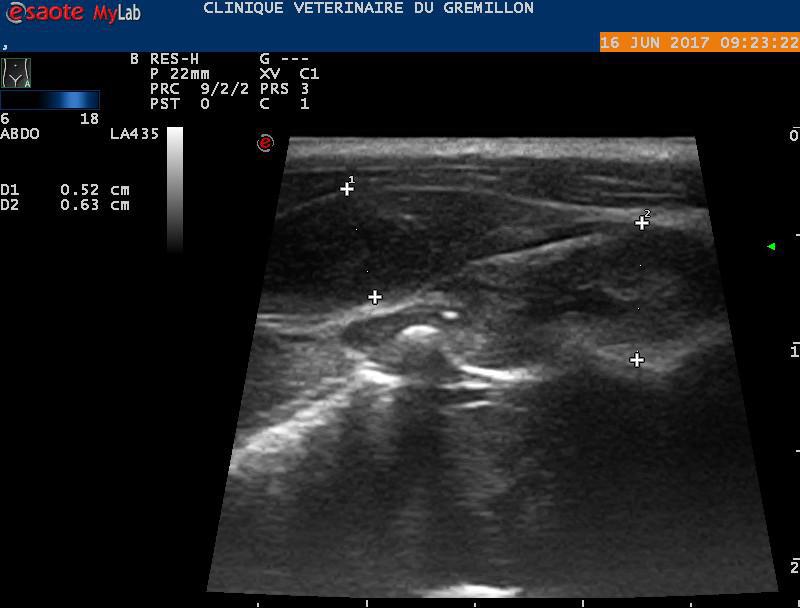 Testicule ectopique en region inguinal