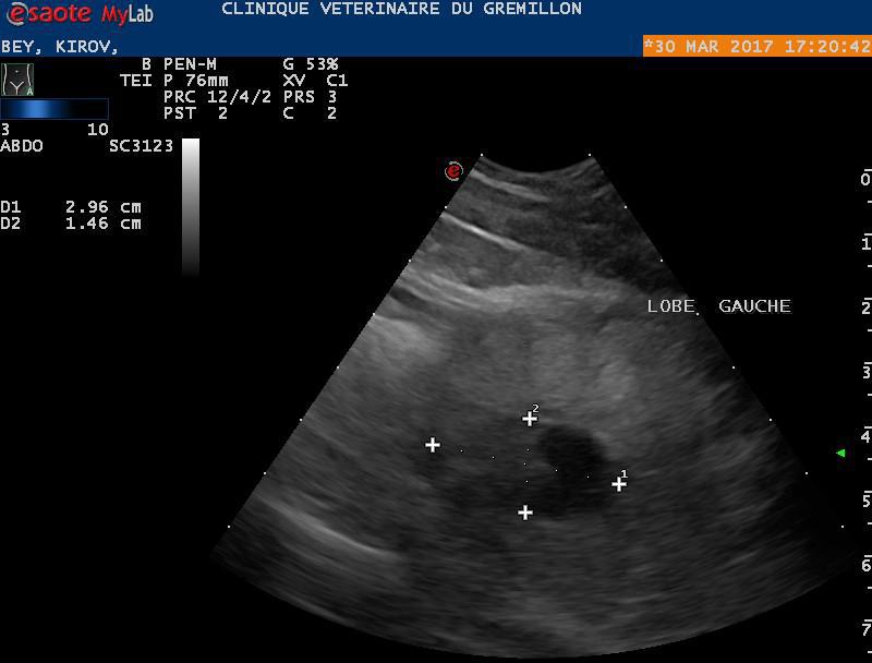 Nodule dans un des deux lobes d'une prostate