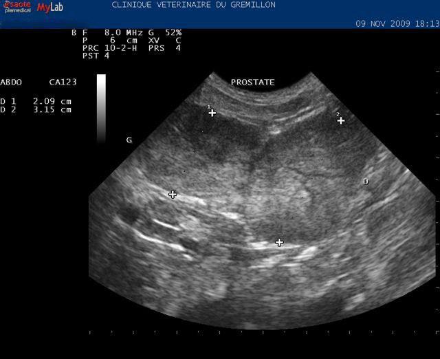 Asymétrie et hypertrophie d'une prostate