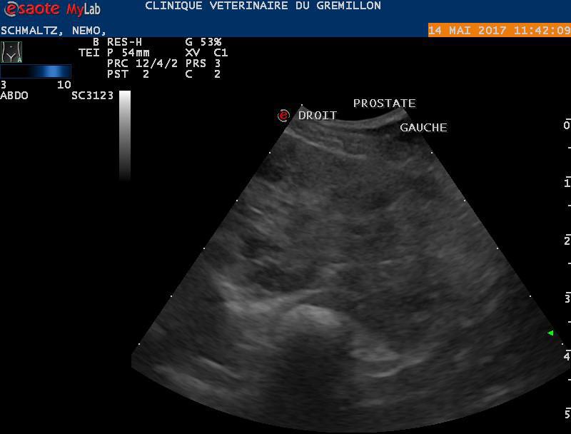 Métaplasie d'une prostate, nombreux petits kystes