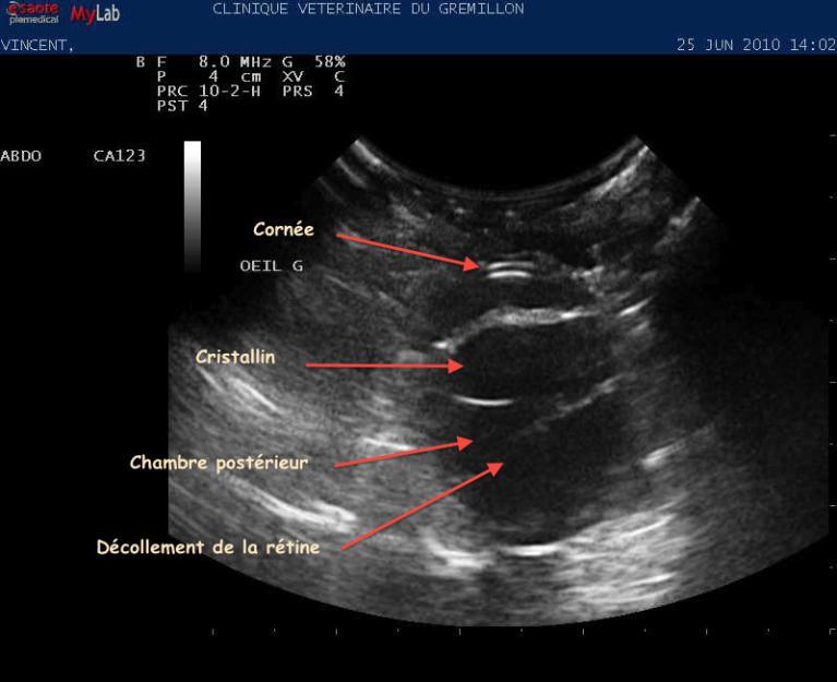 Echographie d'un oeil sain