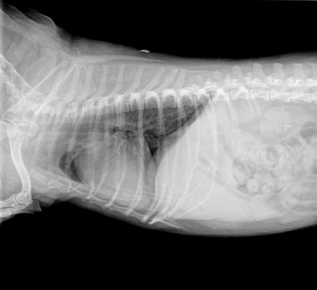 Oedeme pulmoniare cardiogenique (dilatation atriale gauche)