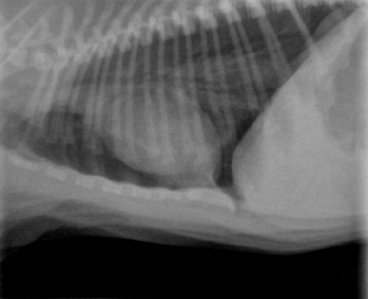 Pneumothorax