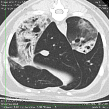 Atelectasie des lobes caudaux G et D suite à de l'asthme