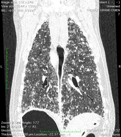 Tumeur pulmonaire diffuse sur un chat