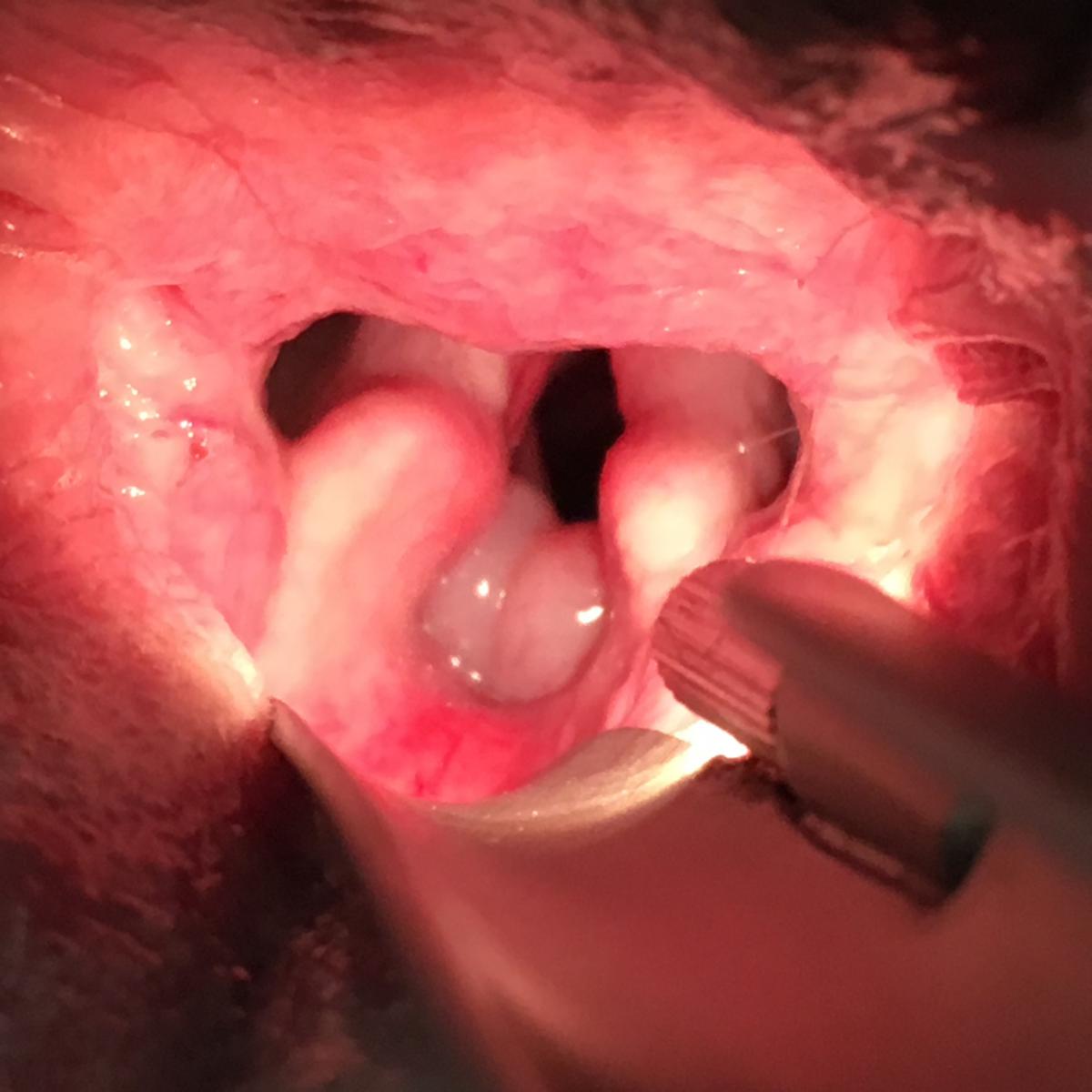 Larynx: Eversion des diverticules laryngés