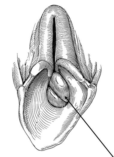 Diverticules LAryngés