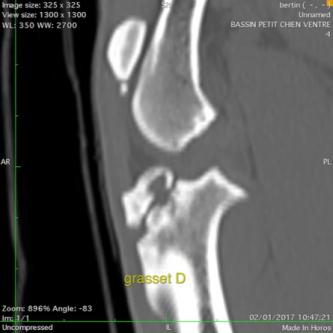 Ancienne fracture tuberosité tibiale