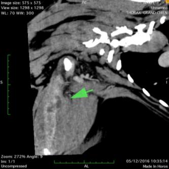 Masse infiltrante dans une cuisse