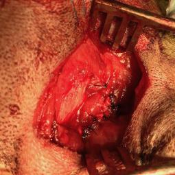 Reduction chirurgicale par suture du muscle perforé