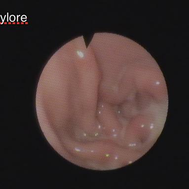 Endoscopie de pylore: Stenose par des plis de muqueuse