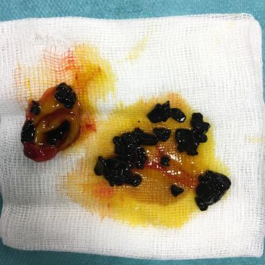 Contenu anormal d'une vésicule biliaire