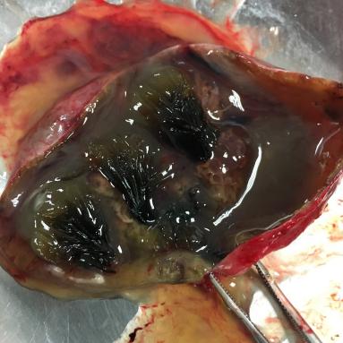 Boue biliaire: Mucocael biliair