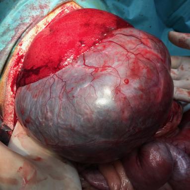 Vésicule biliaire dilatée suite obsruction du canal choledoque