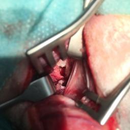 Trépanation de la bulle per-opératoire