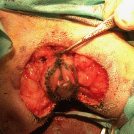 Exerese large d'un lambeau cutané pour supprimer l'intertrigo