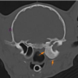 Même polype mais étendu à l'oreille moyenne droite