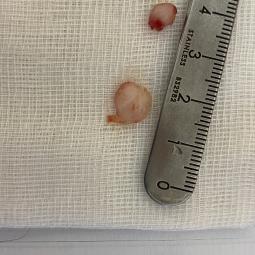 Polypes aprsè exerèse